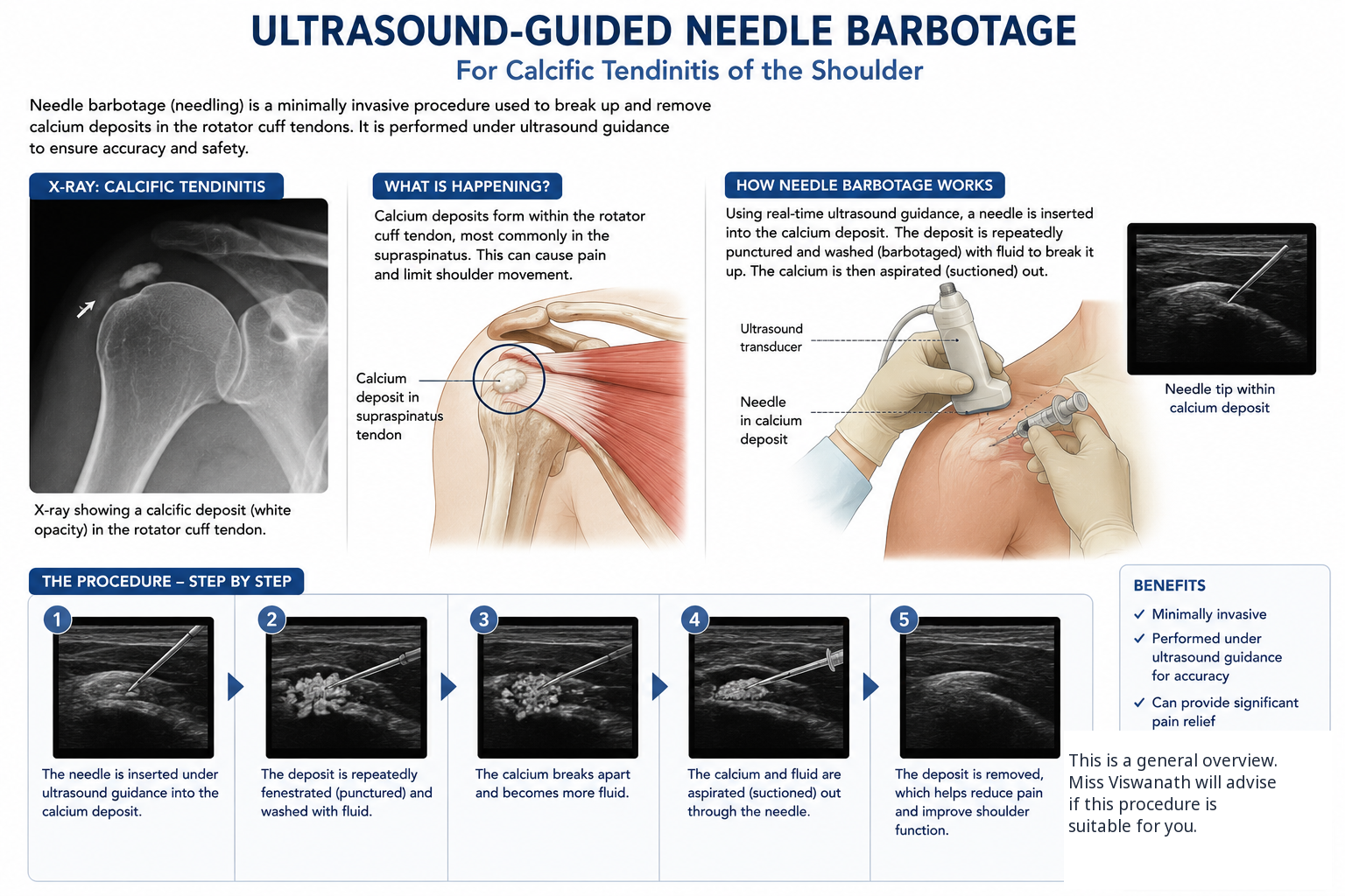 Illustrated guide to ultrasound-guided needle barbotage for calcific tendinitis of the shoulder